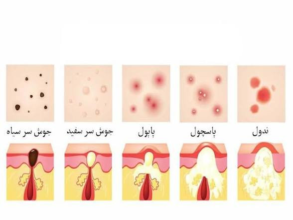 انواع جوش و درمان آن